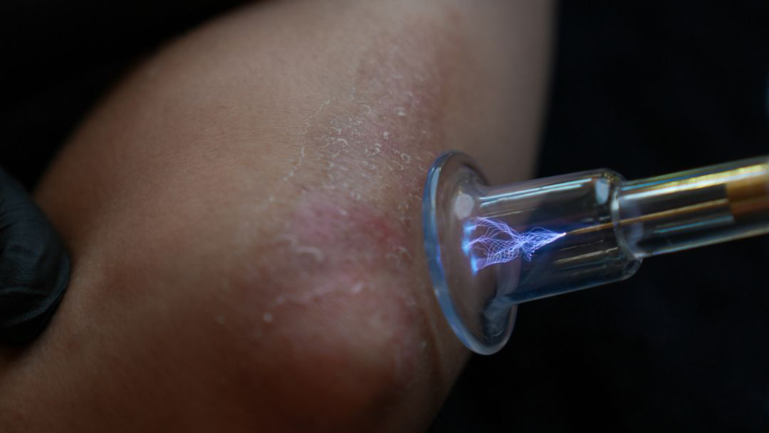 Plasma for Skin Conditions Webinar thumbnail image